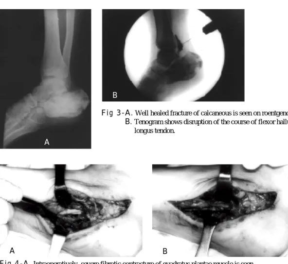 Fig 3-A. Well healed fracture of calcaneous is seen on roentgenogram.
