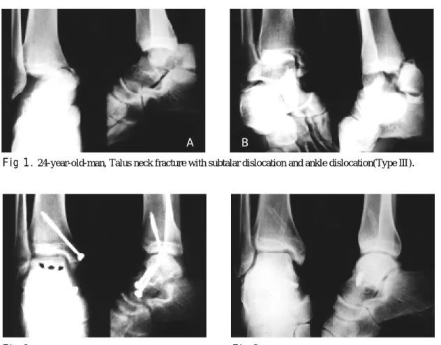 Fig 2. Seven weeks after surgery, Hawkins sign was seen.