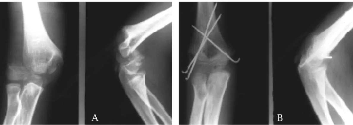 Fig 1. Case 12. A 12+7 year-old boy who is the oldest case in our series.  A. Initial radiographs that show the rare type of flexion injury with anterolateral displacement of the entire distal humeral epiphysis