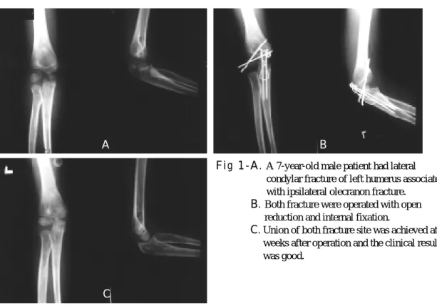 Fig 1- B. Both fracture were operated with open reduction and internal fixation.