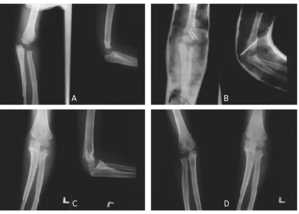 Fig 2-A. A 3-year-old male patient with Milch type II, Jakob stage I fracture.