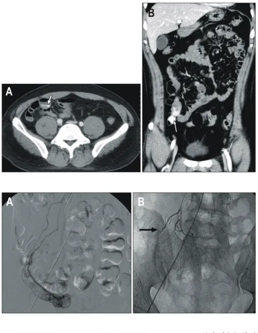 Fig.  2.  (A)  Emergency  angio- angio-graphy  does  not  demonstrate  active  bleeding  focus