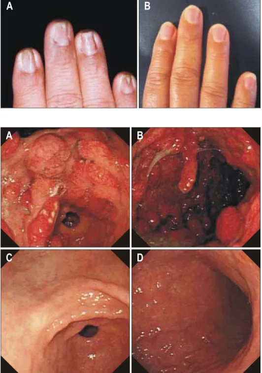 Fig.  1.  Nail  appearance.  (A)  Dys- Dys-trophic  and  hyperDys-trophic  hand  nails  are  seen  on  admission