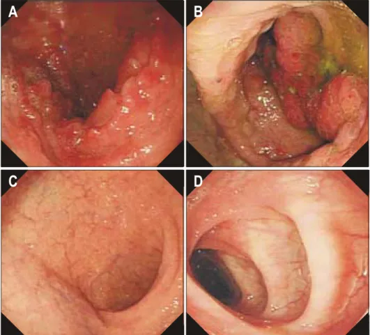 Fig.  3.  Endoscopic  findings  for  duodenum  and  colon.  The  diffuse  polyposis  are  seen  at  duodenum  (A)  and  entire  colon  (B)  on   admis-sion