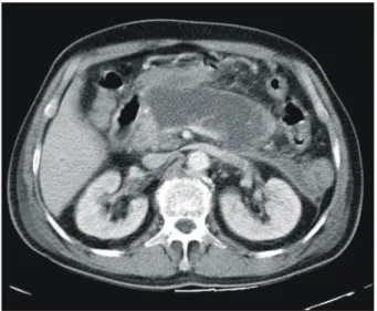 Fig.  1.  Dynamic  abdominal  CT  scan.  It  shows  necrosis  in  central  pancreas  with  acute  fluid  collection,  located  in  residual  pancreatic  head.