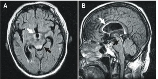 Fig.  2.  Brain  MRI.  (A)  Axial  FLAIR  image  with  gadolinium  enhancement  reveals  abnormal  high  signal  in  the  walls  of  the  third  ventricle  (white  arrow),  medial  thalamic  and  periaqueductal   re-gions  and  tectum  (black  arrow)