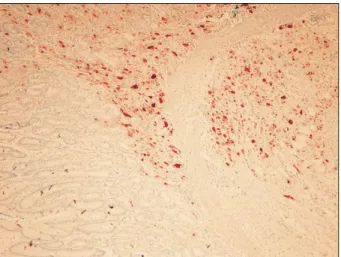 Fig.  2.  Histopathologic  findings  of  specimen  acquired  by  endoscopic  mucosal  resection