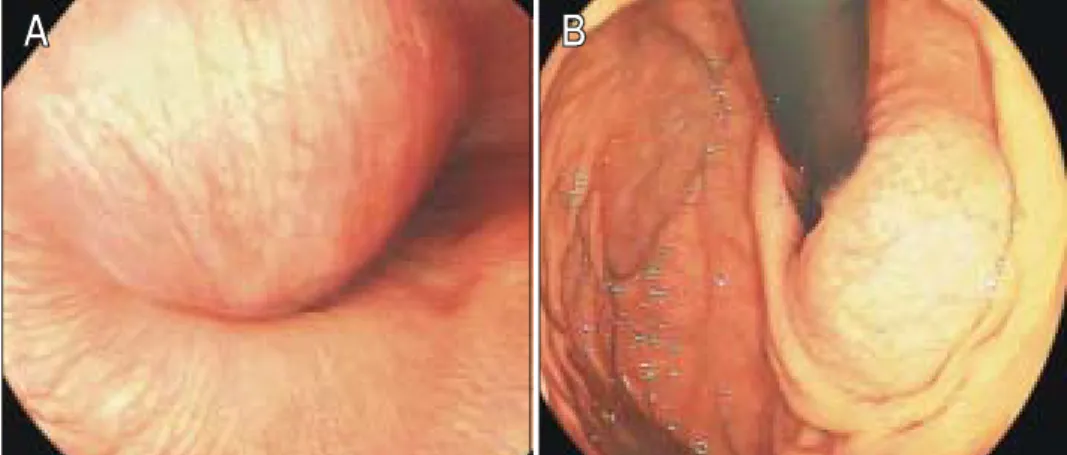 Fig.  2.  Chest  CT  finding.  A  4.8×4.1  cm  sized,  round,  well  defined  and  cystic  mass  is  seen  on  the  medial  aspect  of  esophagus,  at  the  gastroesophageal  junction  level.