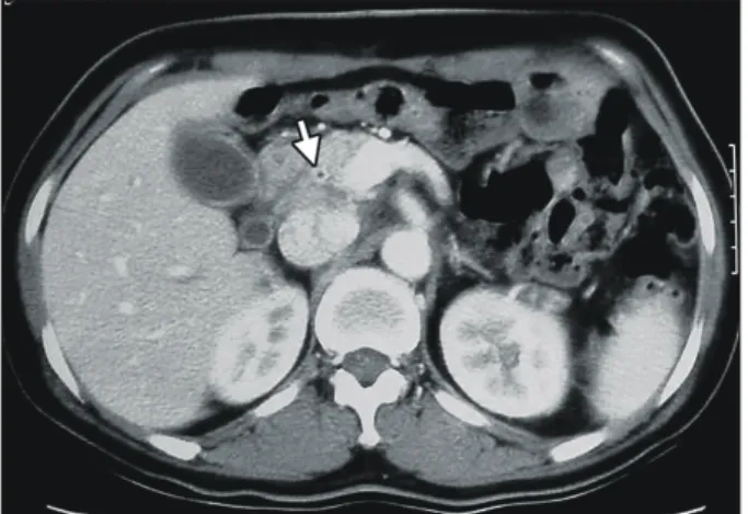 Fig.  3.  ERCP  finding.  A  cholangiography  demonstrates  a  2.5  cm  length  smooth  narrowing  of  the  distal  common  bile  duct  (arrows).