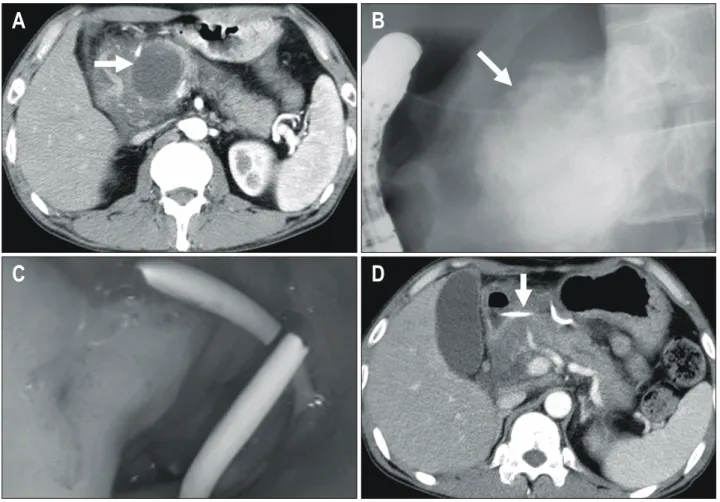 Fig.  2.  Endoscopic  drainage  for  pancreatic  pseudocyst.  (A)  CT  shows  pseudocyst  (arrow)  in  the  pancreas  head