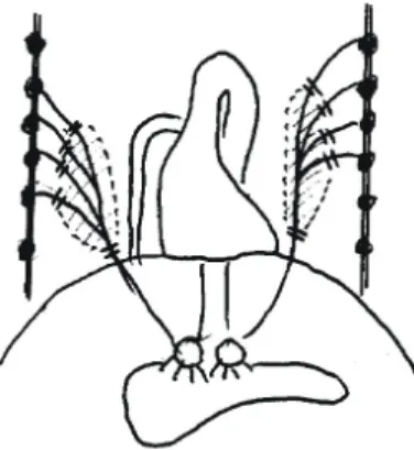 Fig.  3.  The  course  of  great  splanchnic  nerve  and  the  extent  of  neurectomy