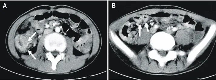 Fig.  1.  CT  scans  of  the  abdomen.  On  contrast  enhancement,  diffuse  wall  thickening  of  the  right  colon  (A)  and  right  side  of  small  bowel  (B)  are  noted  (indicated  by  arrows)
