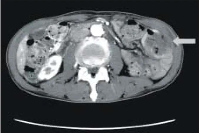 Fig.  2.  Abdominal  CT  finding.  A  mass-like  lesion  with  lobulated  contour  (arrow)  is  noticed