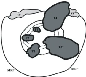 Fig.  3.  Examples  of  the  diverse  T3  rectal  cancers.  All   carcino-mas  are  proven  as  pT3