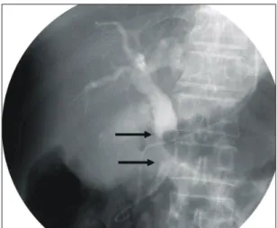 Fig.  2.  ERCP  finding.  It  reveals  a  filling  defect  at  the  mid  common  bile  duct  (arrows)  and  a  dilated  proximal  bile  duct.