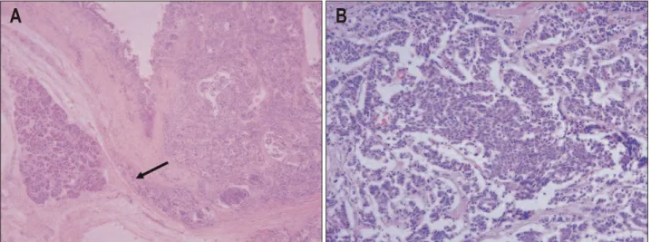 Fig.  5.  Immunohistochemical  studies.  They  show  positive  staining  for  chromogranin  (A)  and  synaptophysin  (B),  respectively  (×200)