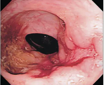Fig.  1.  Colonoscopic  finding.  A  linear  ulceration  is  noted  on  sigmoid  colon.