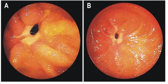 Fig.  1.  Double-balloon  enterosco- enterosco-pic  findings.  Active  ulcer  with  sharp  stricture  formation  is  noted  (A,  B).