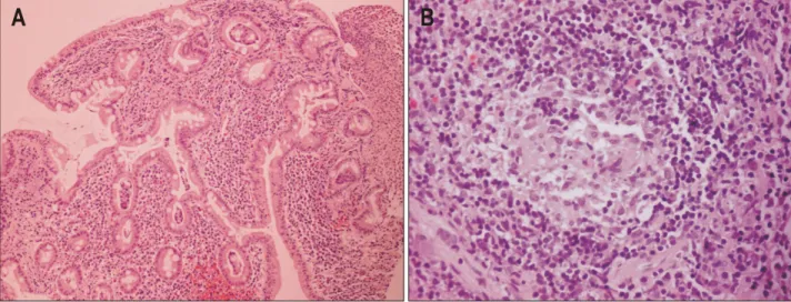 Fig.  2.  Microscopic  findings.  (A)  The  mucosa  shows  marked  mononuclear  cells  infiltration  in  the  lamina  porpria  with  fused,  hyperplastic,  and  irregular  shaped  glands  (H&amp;E  stain,  ×100)