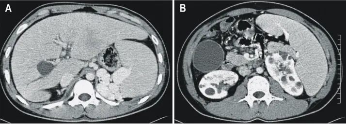 Fig.  2.  Abdominal  CT  finding.  It  shows  ill  defined  low  attenu- attenu-ated  lesion  (arrows)  in  the  lateral  segment  of  left  lobe  of  liver