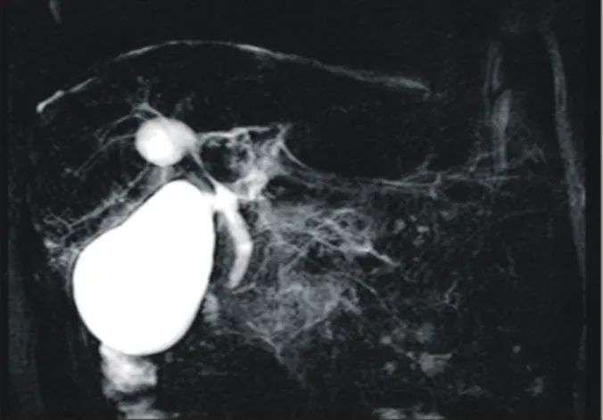 Fig.  5.  Liver  biopsy  finding.  Microscopic  finding  of  ill  defined  low  attenuated  lesion  in  abdominal  CT  shows  infiltration  of  acute  inflammatory  cells  at  periductal  tissue  and  intrahepatic  bile  duct  (H&amp;E  stain,  ×40).