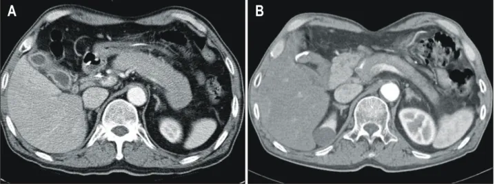 Fig.  1.  Abdominal  CT  findings  in  a  61-year-old  male  patient.  (A)  Before  the  treatment,  the  pancreas  is  diffusely  swollen  without  any  calcification  or  stone