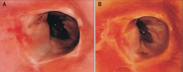 Fig.  5.  Microscopic  finding  of  esophageal  ulcerations.  It  demon- demon-strates  ulcer  detritus  composed  of  fibrinoid  material  and  cellular  debris  devoid  of  malignant  cells  (H&amp;E  stain,  ×200)