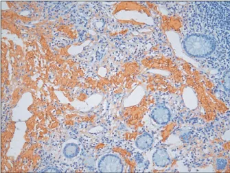 Fig.  5.  Finding  of  immunohistochemical  staining.  Immunohistoche- Immunohistoche-mical  staining  of  tissue  specimen  for  AA  protein  shows  AA  amyloid  deposits  on  blood  vessel  (×400)