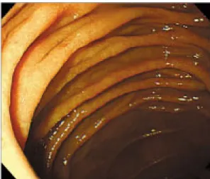 Fig.  1.  Gastroscopic  finding.  Duodenal  2 nd   portion  is  markedly  dilated  without  definite  obstructive  lesion.