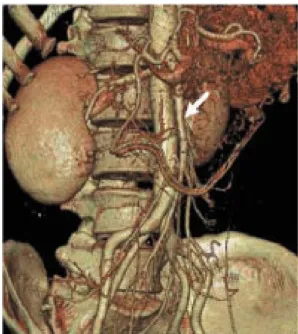 Fig.  4.  Duodenographic  finding.  It  shows  a  distended  2 nd   and  3 rd portion  of  the  duodenum  and  vertical  extrinsic  compression  of  the  duodenal  3 rd   portion
