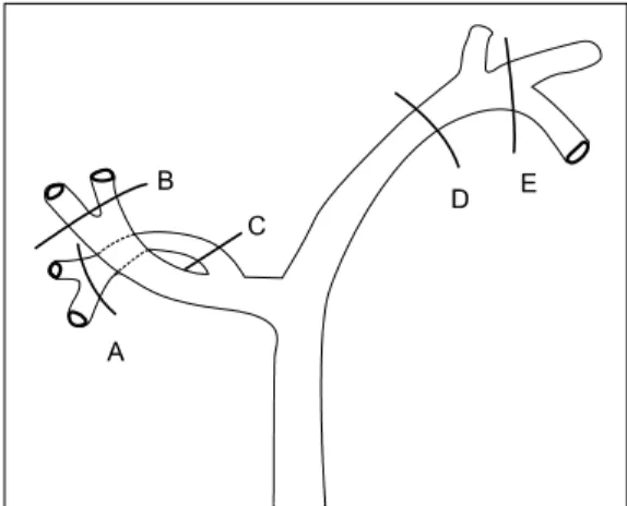 Fig.  1.  Type  of  liver  resection  depending  on  the  division  line  of  intrahepatic  bile  duct