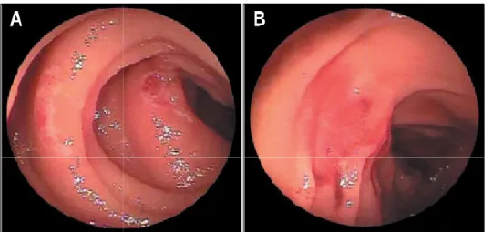 Fig.  1.  Double  balloon  enter- enter-oscopy  findings  in  obscure   ga-strointestinal  bleeding