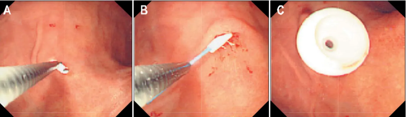 Fig.  2.  (A)  Endoscopy  shows  oozing  from  a  large  varix  in  the  gastric  fundus  on   retro-flexed  view