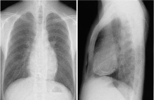 Fig.  1.  Chest  PA  and  lateral.  It  shows  pericardial  calcification.