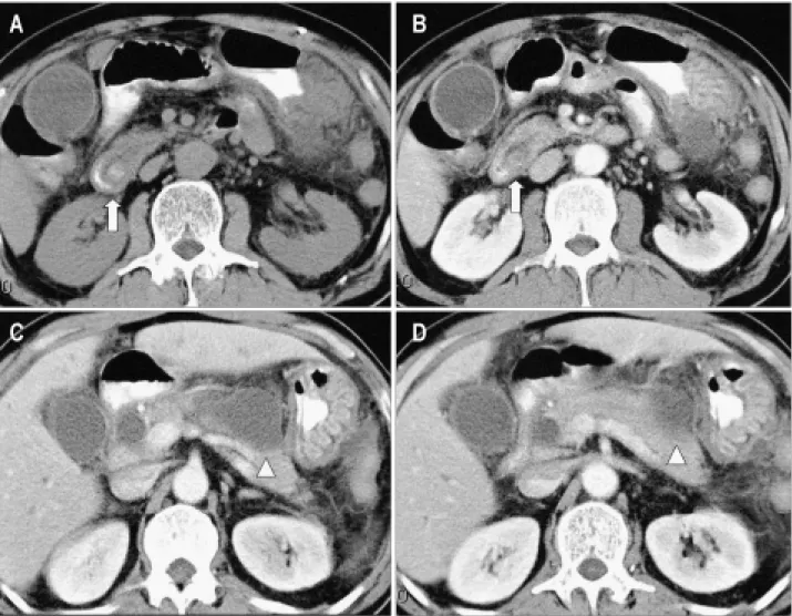 Fig.  1.  CT  on  admission.  (A)  A  nodular  calcified  density  in  distal  end  of  common  bile  duct  (arrow)