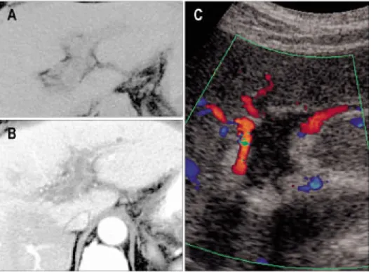 Fig.  2.  ERCP  on  2 nd   hospital  day.  About  2.3  cm  filling  defect  in  distal  common  bile  duct  and  dilated  bile  duct.
