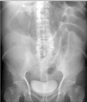 Fig.  1.  Simple  abdominal  X-ray  shows  small  and  large  bowel  dilatation.  This  finding  suggested  the  possible  distal  large  bowel  obstruction.