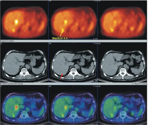 Fig.  3.  Sigmoidoscopic  finding.  Huge  ulcerofungating  mass  replaced  nearly  entire  colonic  lumen  and  spontaneous  bleeding  is  noticed  on  the  tumor  surface.