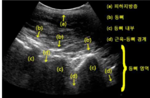 그림 2. 이진화된 요부 초음파 영상 Fig. 2. Binarized Ultrasonic Lumbar Image