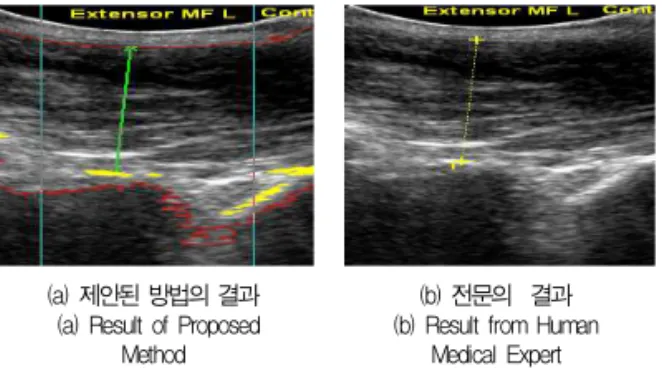 표 2는 요부 초음파 영상에 대해 제안된 근육 두께 측정 방법과 전문의가 근육 두께를 측정한 방법 간의 오차를 나타 내었다.