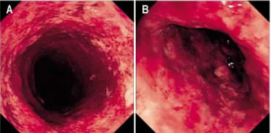 Fig. 1. Sigmoidoscopic findings.