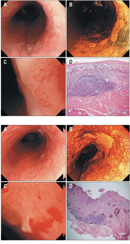 Fig.  1.  Endoscopic  pictures  of  dysplastic  lesion.  (A)   Conventio-nal  view.  (B)  After  Lugol's  solution