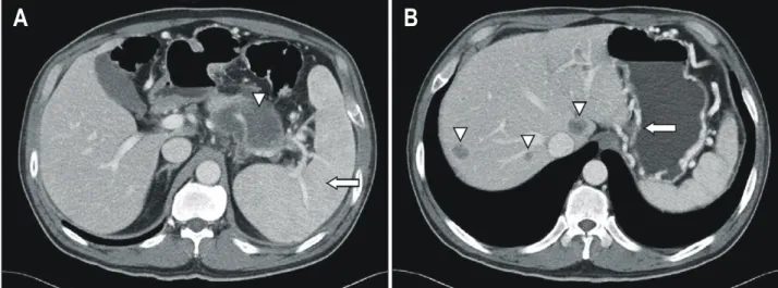 Fig.  2.  Abdominal  computed  tomography  scan  findings.  Splenomegaly  is  noted  (arrow)
