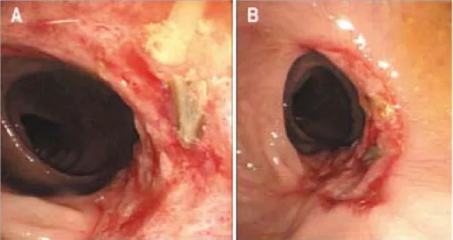 Fig.  1.  Ulcer  with  bleeding  was  noted  in  descending  colon.