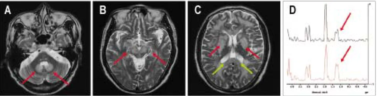 Fig.  1.  T2-weighted  images  (A-C)  during  symptom  period  show  high  signal  intensities  in  dentate  nucleus  (A,  arrows),  midbrain  (B,  arrows),  basal  ganglia  (C,  red  arrows)  and  corpus  callosum  (C,  green  arrows)