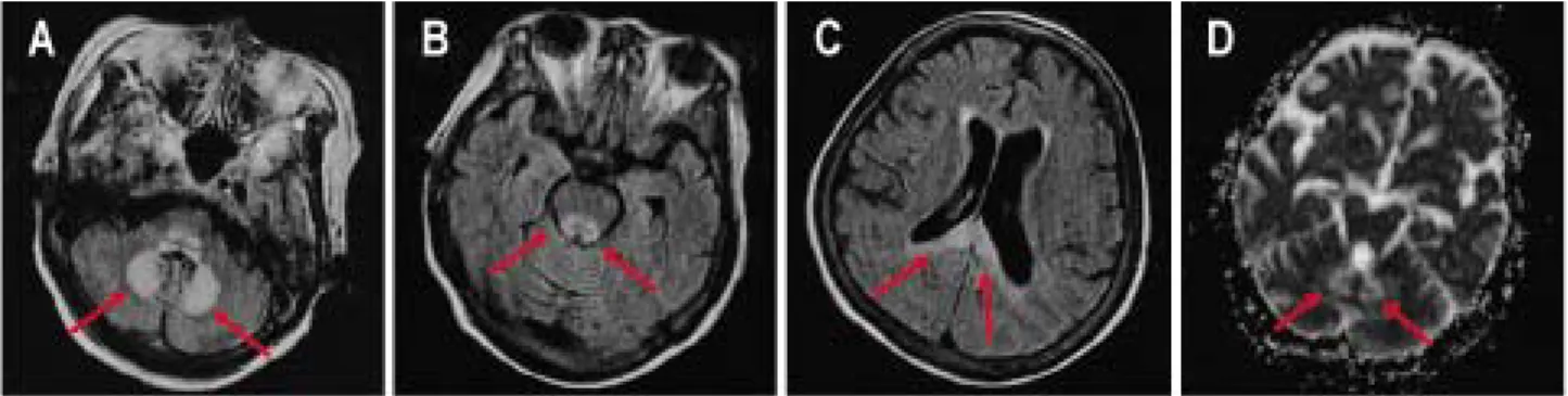 Fig.  3.  Axial  fluid-attenuated  inversion  recovery  (FLAIR)  images  at  symptom  onset  show  high  signal  intensities  in  dentate  nucleus  (A,  arrows),  midbrain  (B,  arrows)  and  corpus  callosum  (C,  arrows)