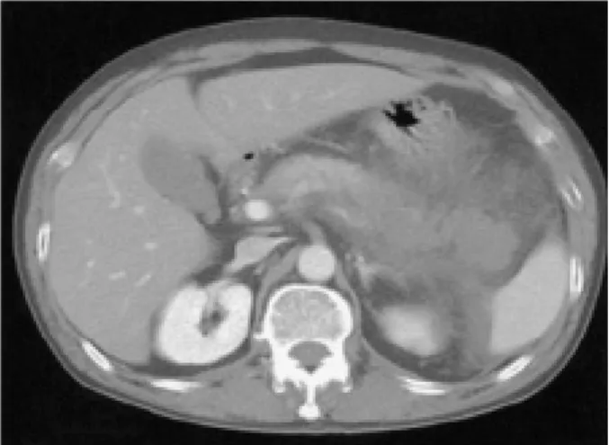 Fig.  2.  Abdominal  CT  finding  at  the  first  admission.  Loop  of  transverse  colon  is  not  dilated.