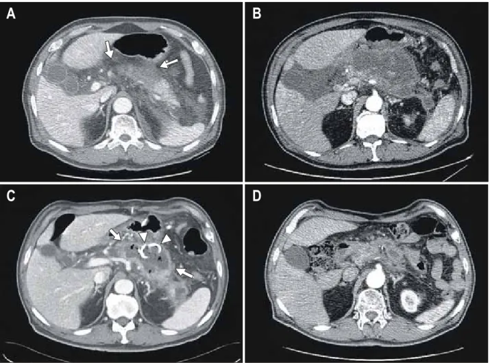 Fig.  1.  (A)  Initial  CT  scan  shows  severe  pancreatic  necrosis  with  peripancreatic  fluid  collection  in  pancreatic  body  (arrow)