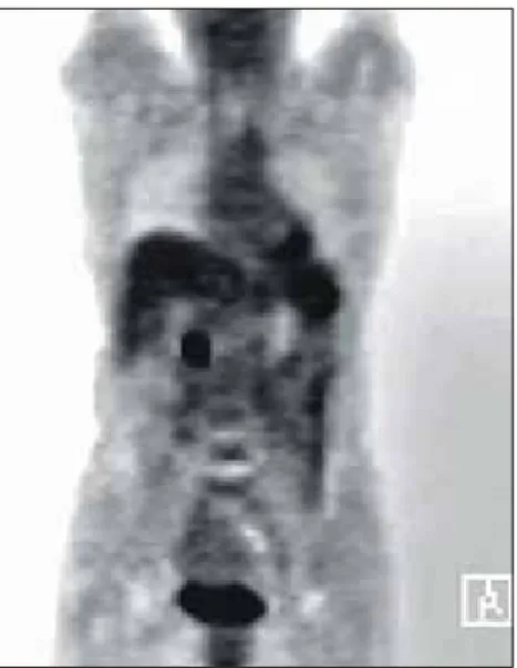 Fig.  1.  F-18  FDG  PET  scan.  It  shows  a  focal  hypermetabolic  lesion  on  the  ampulla  of  Vater