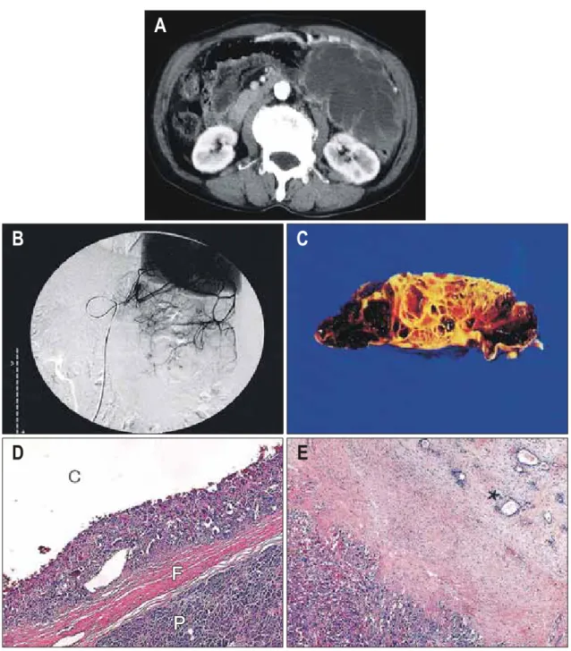 Fig.  1.  Radiologic  and  pathologic  findings  of  case  1.  (A)  Abdominal  CT  scan  in  arterial  phase